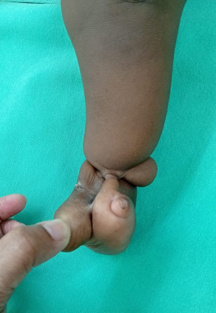 Surgical outcome & awareness: Congenital Constriction Ring Syndrome 0268e4ad 3d55 470e 81d1 4f88a22d32af