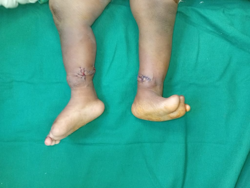 Surgical outcome & awareness: Congenital Constriction Ring Syndrome 1135381e d6f8 420b a974 8d7bd441fde1