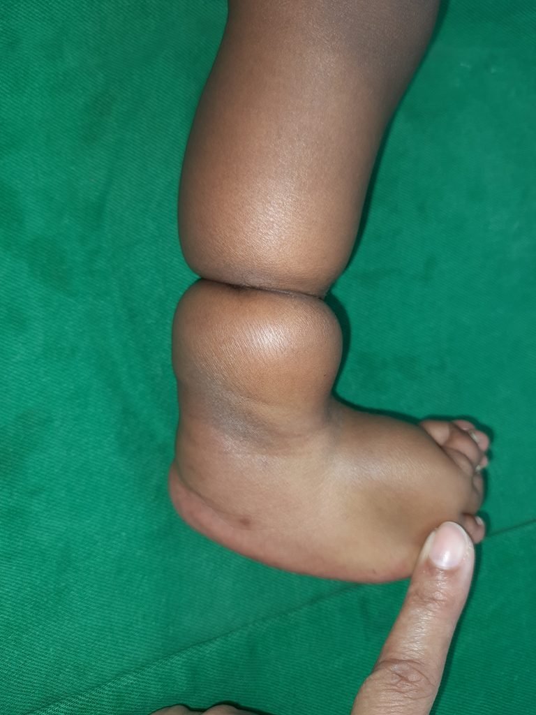 Amniotic Band involving lower leg