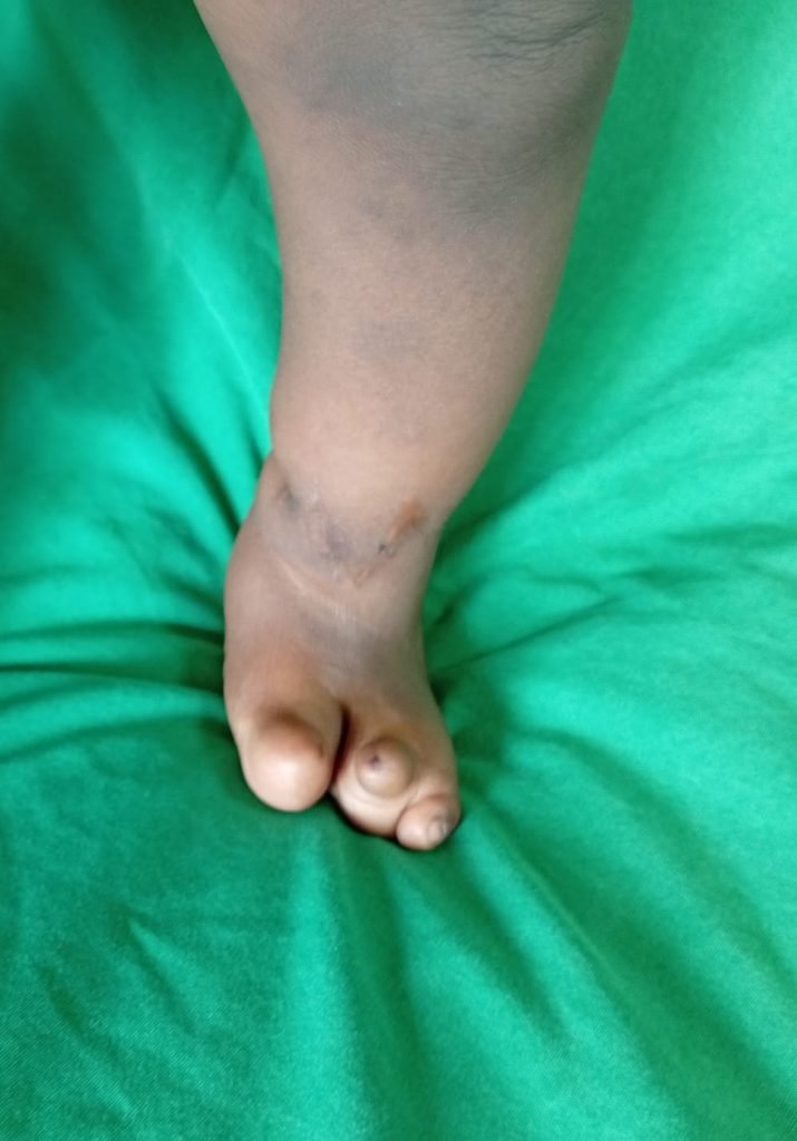 Surgical outcome & awareness: Congenital Constriction Ring Syndrome 8c458a42 60b9 4fae a41a e15f9fcfd3cb