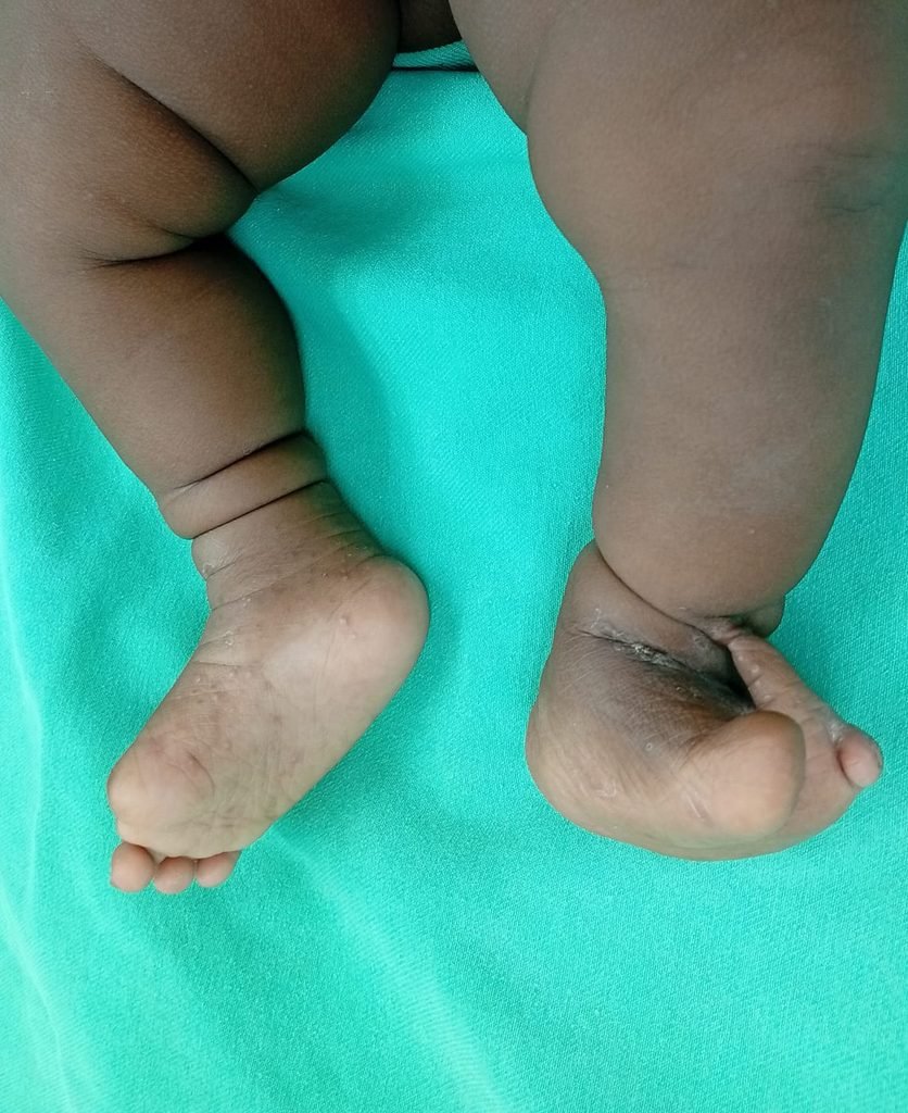 Surgical outcome & awareness: Congenital Constriction Ring Syndrome a043c5b1 ba50 4724 a9f0 3d0bc1656563