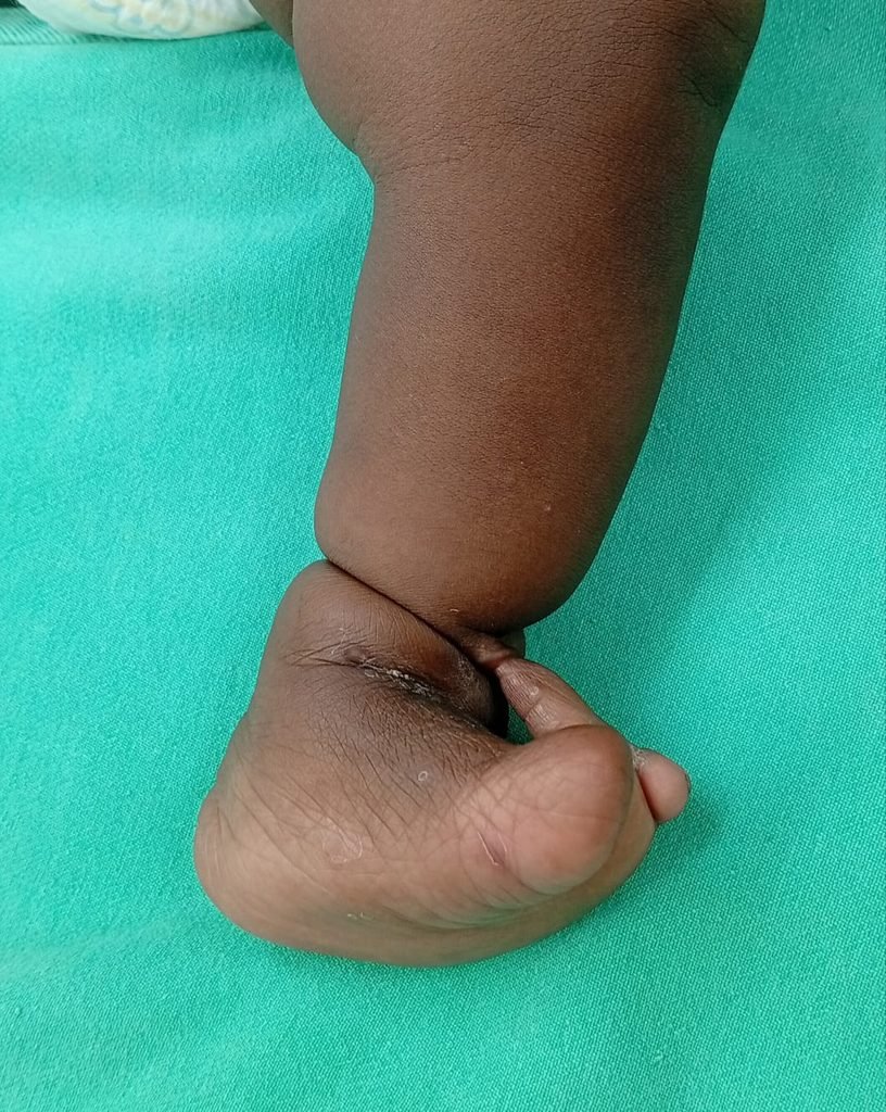Surgical outcome & awareness: Congenital Constriction Ring Syndrome efae29be 8919 47e5 9617 c1fdbf83751e